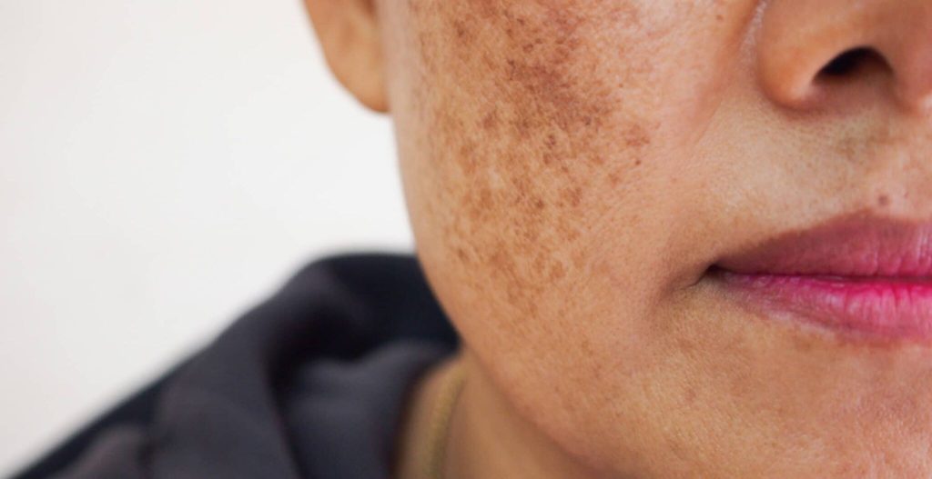 Read more about the article Everything You Need to Know About Hyperpigmentation