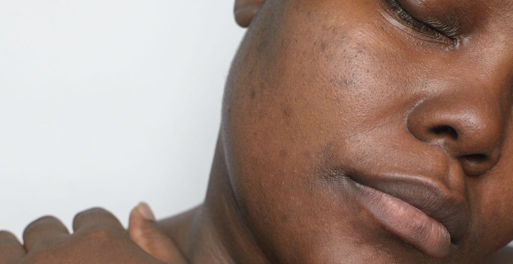 Read more about the article Understanding Hyperpigmentation in Melanin-Rich Skin