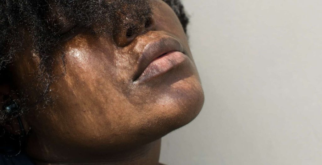 Read more about the article Pigmentation Concerns Lips Hyperpigmentation
