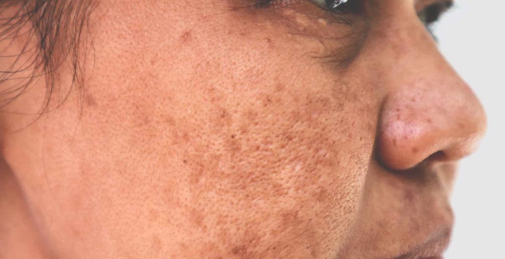 Read more about the article Pigmentation Concerns Post Inflammatory Hyperpigmentation